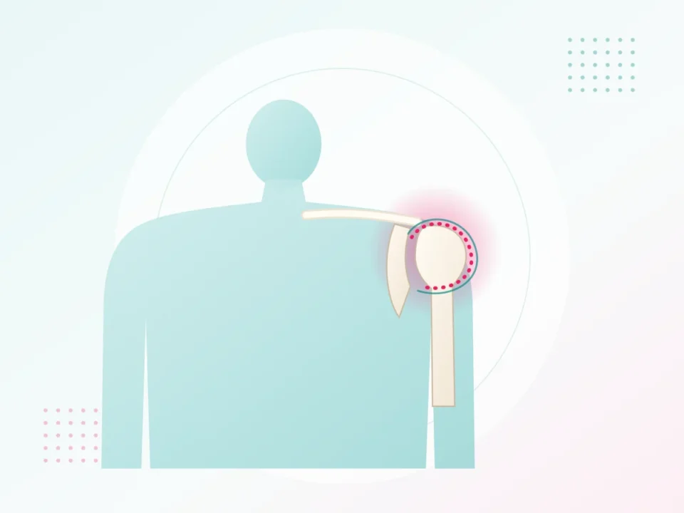 Illustration of a frozen shoulder with a tight, painful joint capsule – frozen shoulder treatment at UR Physio Clinic, Murlipura, Jaipur