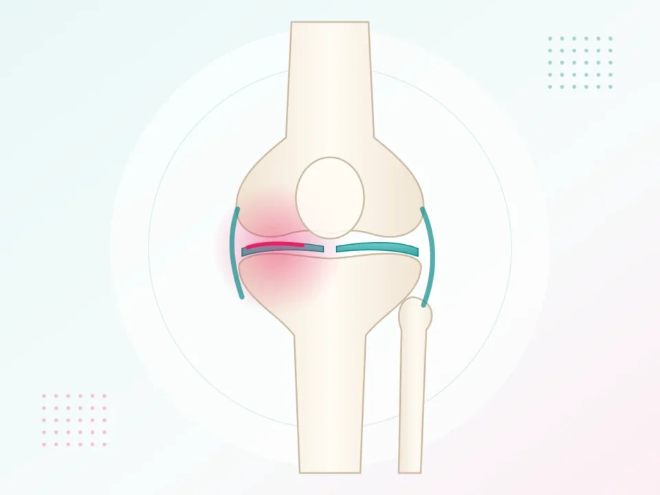 Illustration of a knee joint with worn, painful cartilage – physiotherapy for knee pain at UR Physio Clinic, Murlipura, Jaipur
