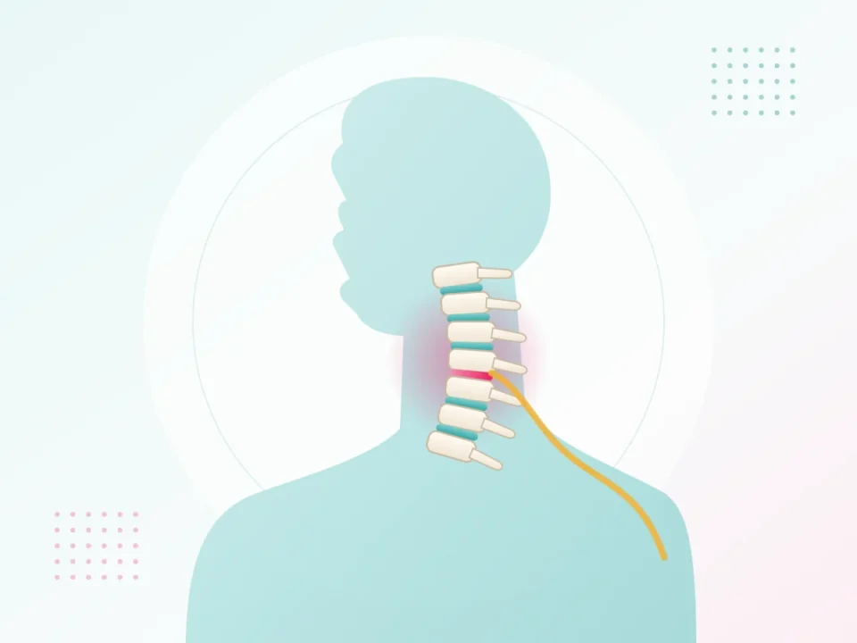 Illustration of neck pain from the cervical spine with a nerve spreading to the shoulder – neck pain physiotherapy at UR Physio Clinic, Murlipura, Jaipur