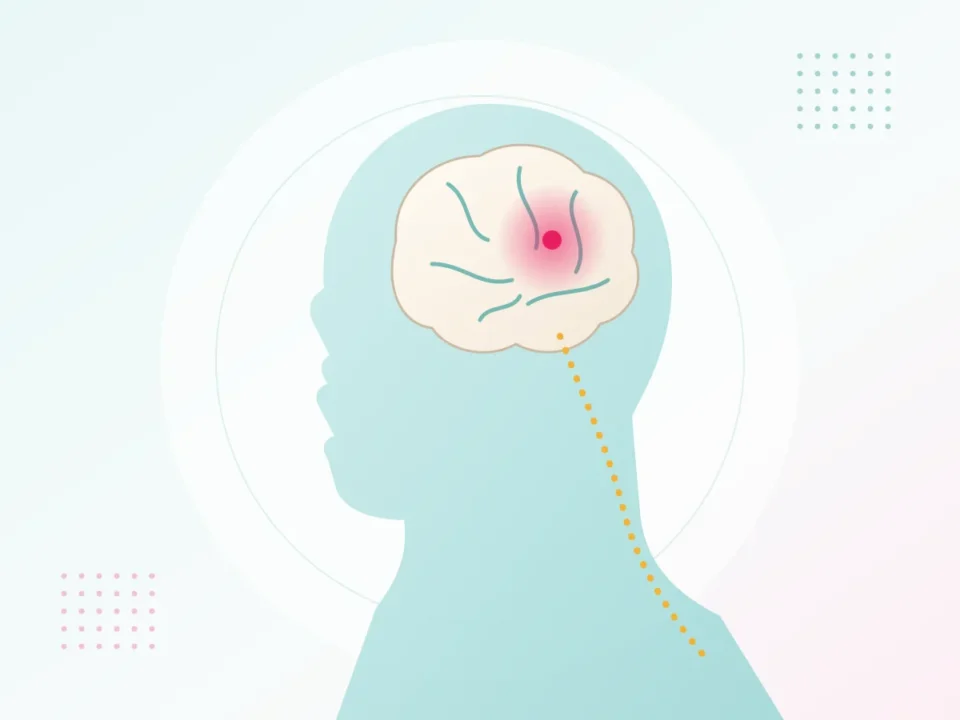 Illustration of the brain after a stroke and the nerve pathway to the body – paralysis and stroke physiotherapy at UR Physio Clinic, Murlipura, Jaipur