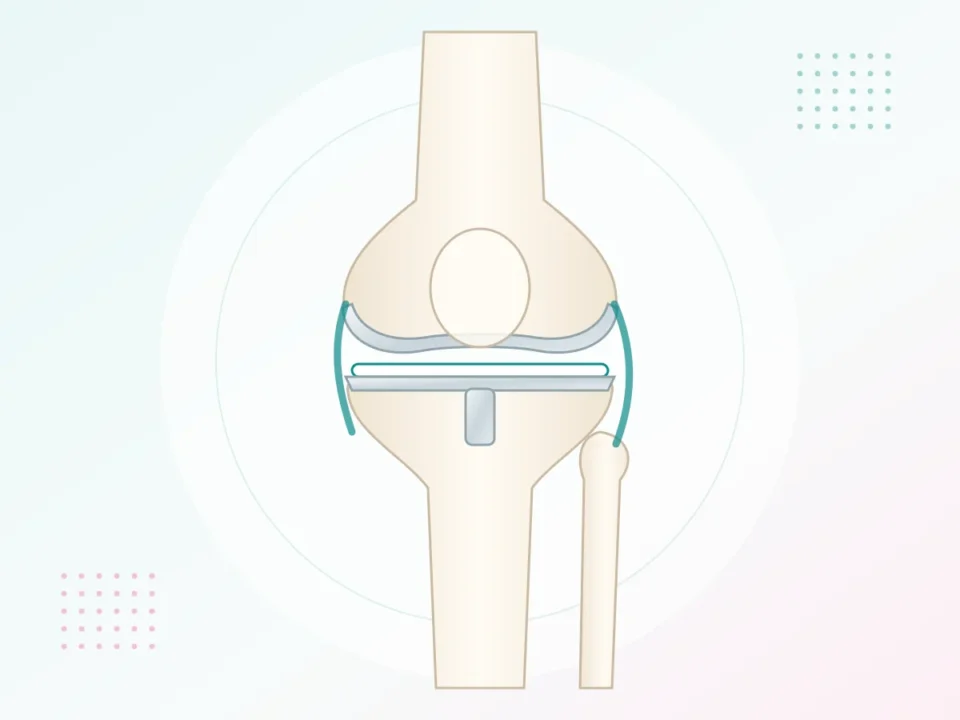 Illustration of a knee joint with a knee replacement implant – post-surgery rehabilitation at UR Physio Clinic, Murlipura, Jaipur