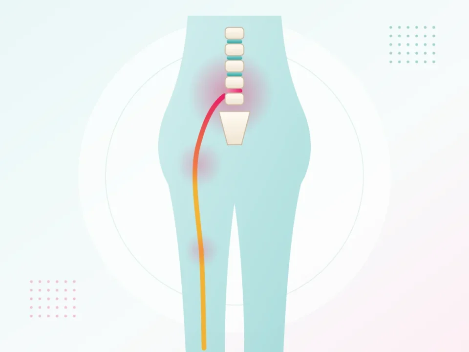 Illustration of sciatica with nerve pain travelling from the lower back through the buttock and down the leg – sciatica treatment at UR Physio Clinic, Murlipura, Jaipur