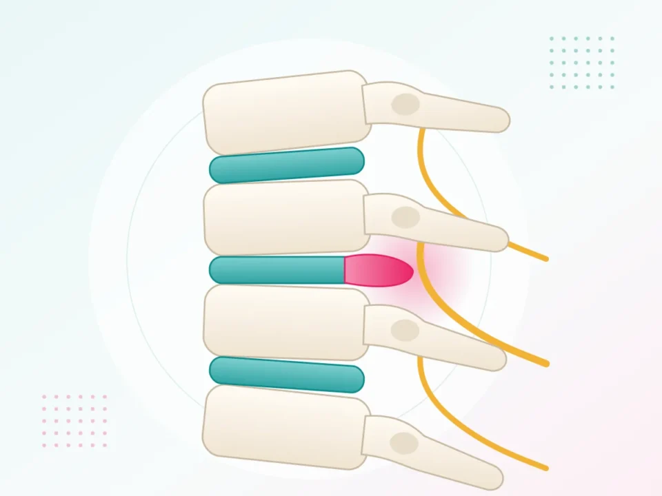 Illustration of a slip disc (disc bulge) in the lower spine pressing on a nerve root – slip disc treatment at UR Physio Clinic, Jaipur