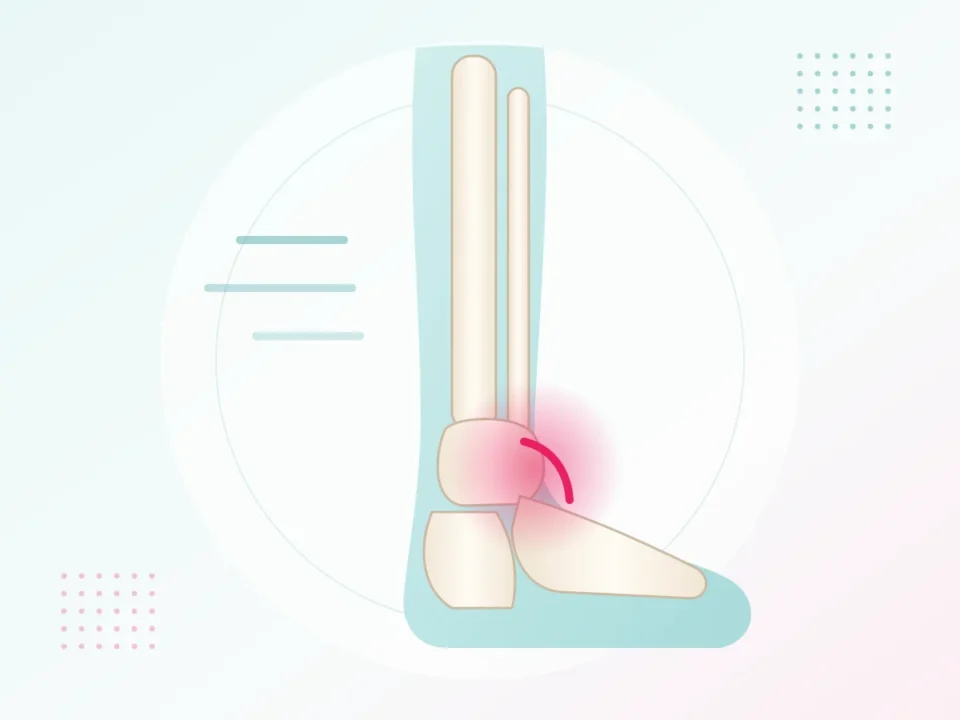 Illustration of an ankle ligament sprain – sports injury physiotherapy at UR Physio Clinic, Murlipura, Jaipur